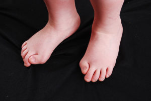 Child's foot with malformed big toes